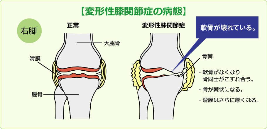 変形性膝関節症の病態