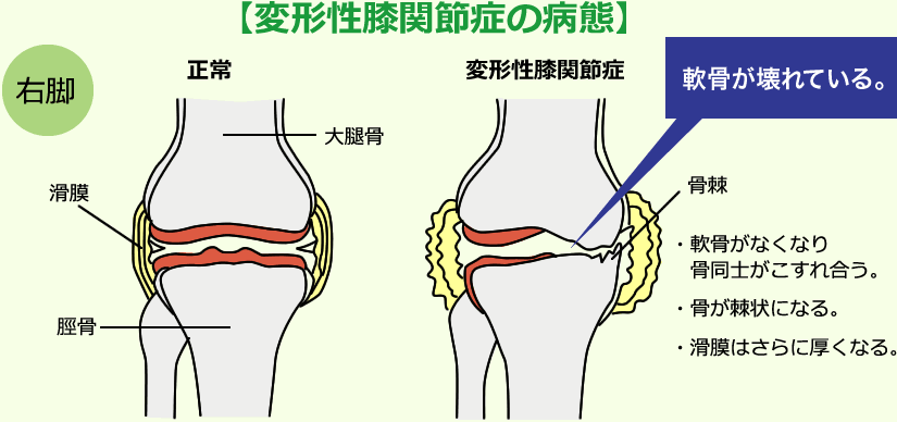 変形性膝関節症の病態